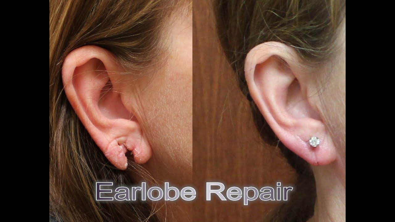 Ear Repair Torn Gauged Earlobe Houston TX