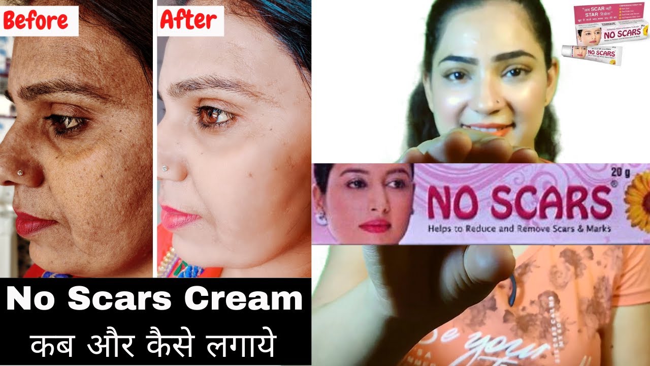 No Scars Cream For Scars, Dark Spots&Fair Full Review In Hindi l