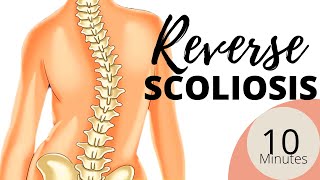 Reverse SCOLIOSIS | Stretch and Strengthen | LEFT HIP SHIFT - with Nichelle Thomson