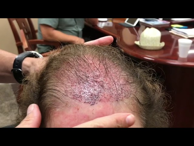 Female Hair Transplant Patient Post Op