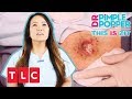 This is Zit: Pickel ausdrücken | Dr. Pimple Popper | TLC Deutschland