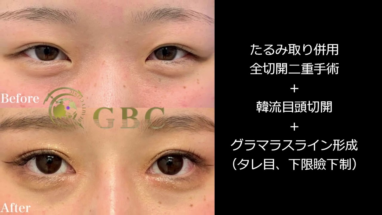 症例 二重手術 たるみ取り併用全切開二重手術 韓流目頭切開 グラマラスライン形成 タレ目 下限瞼下制 グローバルビューティークリニック杉崎裕斗症例 杉崎裕斗 Youtube