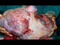 World&#39;s Largest Cysts by Blackhead King   Ovarian Cyst