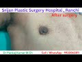 Grade 1 Gynecomastia surgery in Ranchi| Scarless Gynecomastia surgery|™Best Gynecomastia surgery