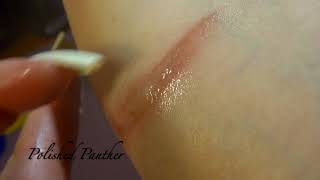 I got a 2nd degree burn | second degree burn