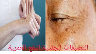 البقع العمرية/التصبغات الجلدية:اسبابها،علاجها و كيفية الحماية منها