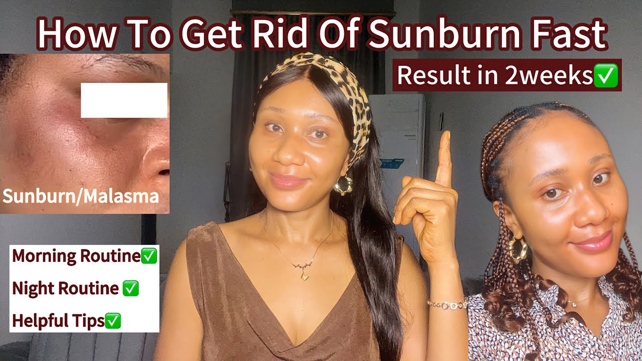 How to Get Rid of Heat Rash: 7 Quick Remedies