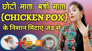 चेचक (छोटी माता / बड़ी माता) के दाग चेहरे या शरीर से कैसे मिटाएं । How To Remove chicken Pox Scar
