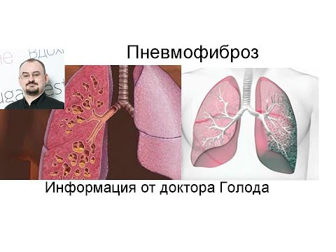 Как лечить пневмофиброз - фиброз лёгких?