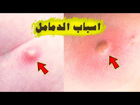 اسباب ظهور الدمامل