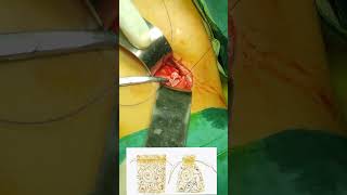 Purse String Suture live video. Tips to take purse string suture.