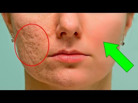 How To Prevent And Fade Acne Scars Fast