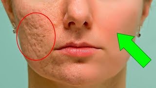 How To Get Rid Of Acne Scars And Pimple Marks screenshot 5