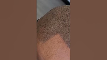 Scalp Micropigmentation close up