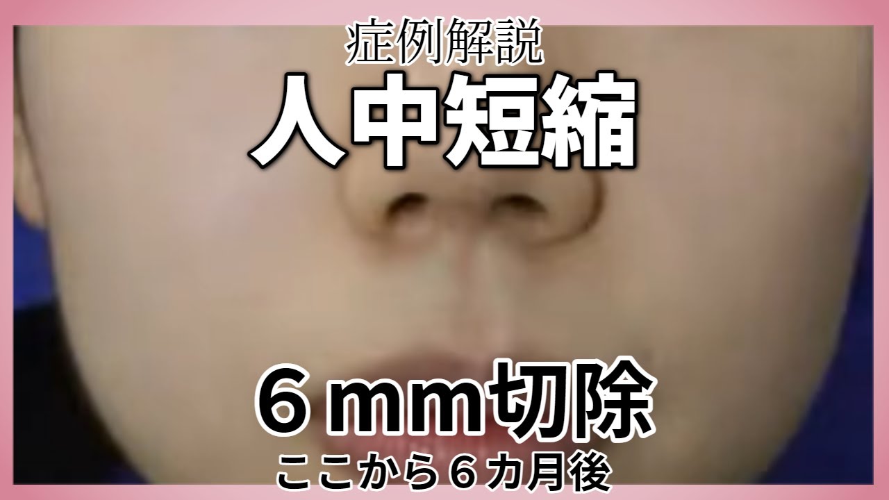 鼻下の整形。人中短縮術　6か月の症例解説。名古屋こいずみ形成クリニック