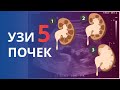 УЗИ почек. Часть 5. Степени Гидронефроза и его дифференциаьная диагностика