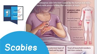 Scabies diagnosis and treatment | د. معاذ طحان