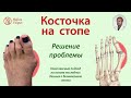 Косточка на стопе.  Решение проблемы.