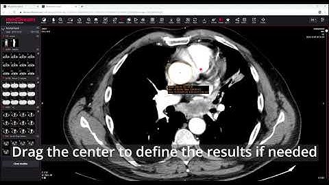 MedDream DICOM Viewer: measure the ellipse
