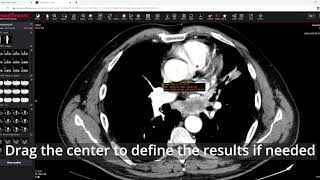 MedDream DICOM Viewer: measure the ellipse