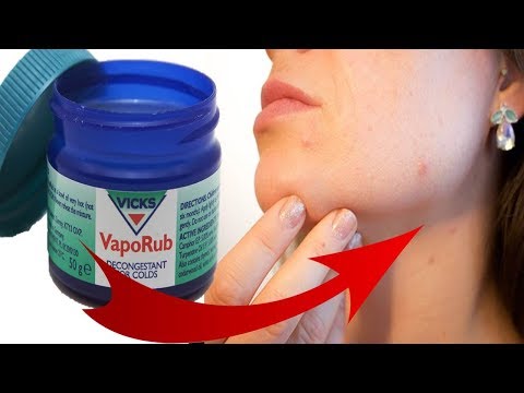 How to Use Vicks Vaporub for Pimples, Acne Scars & Facial Redness
