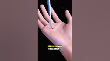 💥 “Tiny Splint, Big Healing! 😱 How Mallet Finger Gets Fixed Fast! 🖐️ #MedicalFacts” #shorts #viral