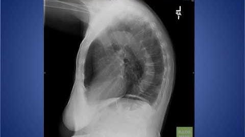 Radiology Rounds 023 Basic Approach to Chest X-Ray , Lateral Chest