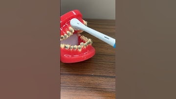Hướng dẫn vệ sinh răng niềng bằng Bàn chải điện  #dentist #niengrang #orthodontist #niềngrăng