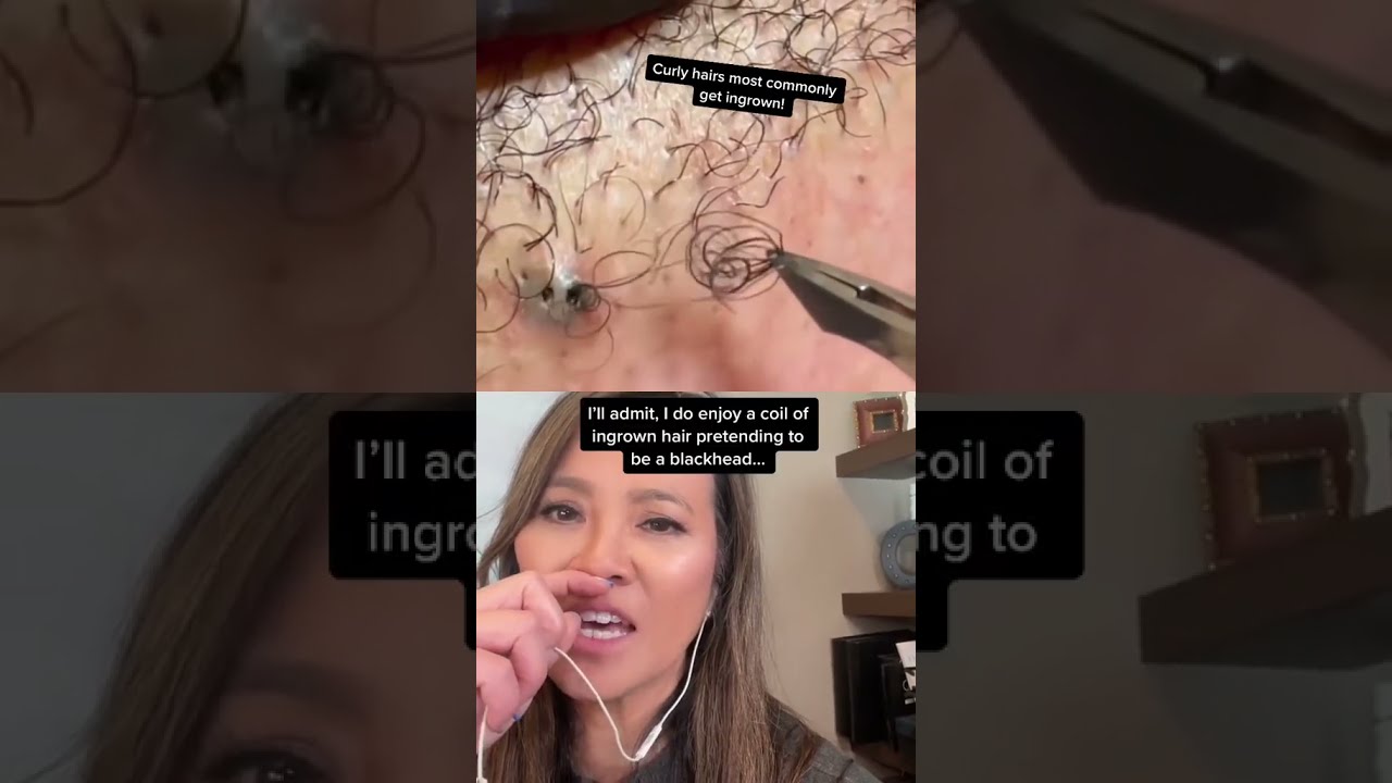 Don T Send Me Abscesses On Livestock Great Ingrown Hair Removals Shorts