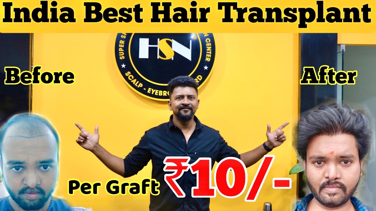 BEST HAIR TRANSPLANT ₹10 /- Per Graft / Best Price in Tamilnadu HSN / Nanga Romba Busy