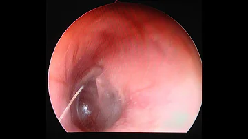 Onde se encontra o tímpano?
