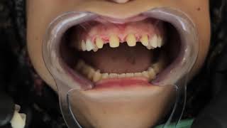 تقويم الأسنان أو التركيبات التجميلية في الأردن/ دكتور أكرم الأدهمي
