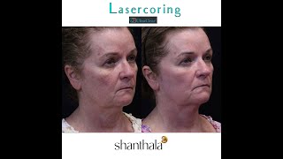 Ultraclear lasercoring Boston, patient journey