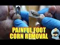 Painful Deep Foot Corn with Callus Removal Surgery