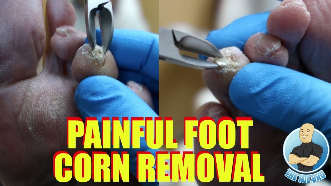 Painful Deep Foot Corn with Callus Removal Surgery 