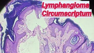 Lymphangioma Circumscriptum Basics