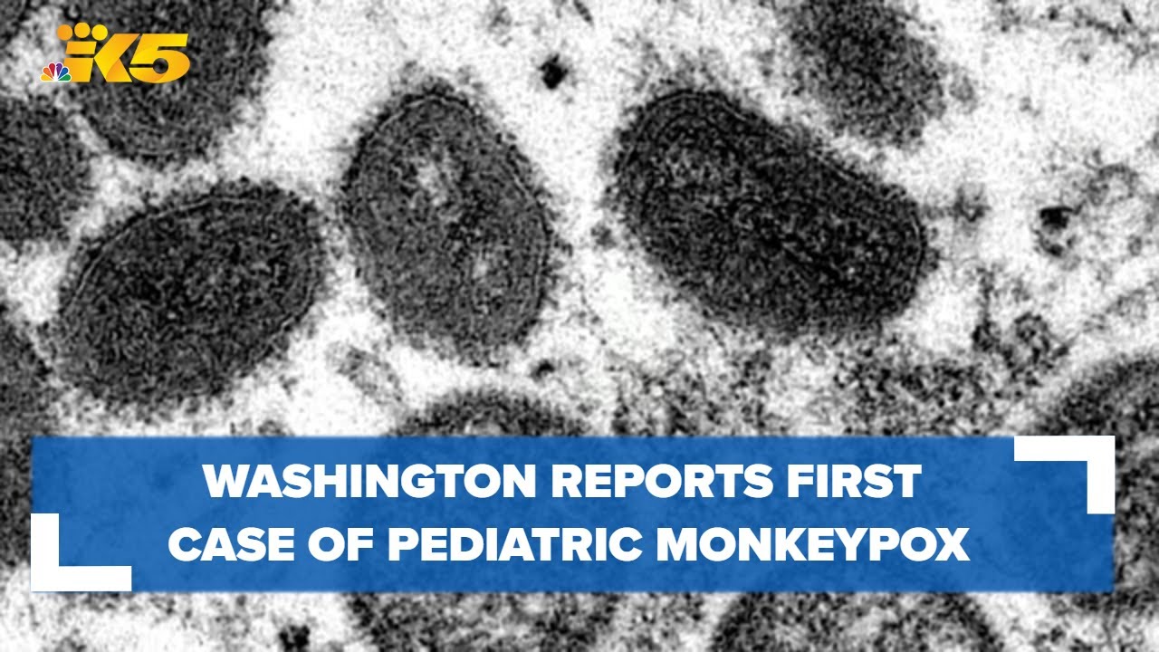Washington reports first pediatric monkeypox case - YouTube