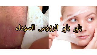 افضل الطرق الطبيعيةلازالة الرؤوس_السوداءوالتخلص من حب_الشبابوآثاره من اول استعمال