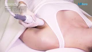 LIFTERA - Non Invasive Body Contouring with Pen Applicator