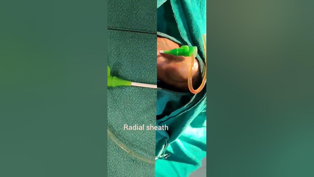 angiography 🫀 | angio heart problems 💊| cardiology 🫀#heart #angiogram #shotsfeed @Utype197 #viral