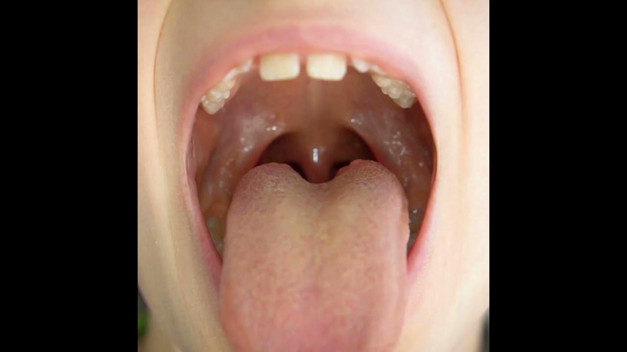 view-of-the-uvula-and-the-soft-palate-of-little-girl-pediatric