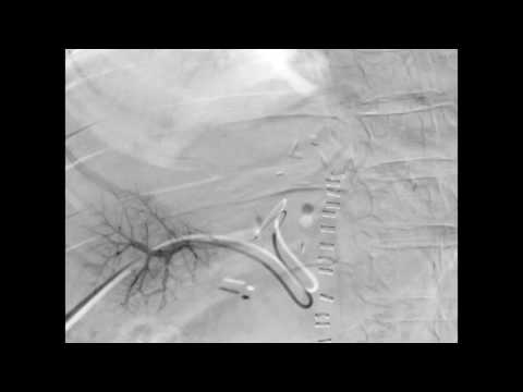 Portal Vein Embolization / Glubran2 :Editted by Tony Aoun