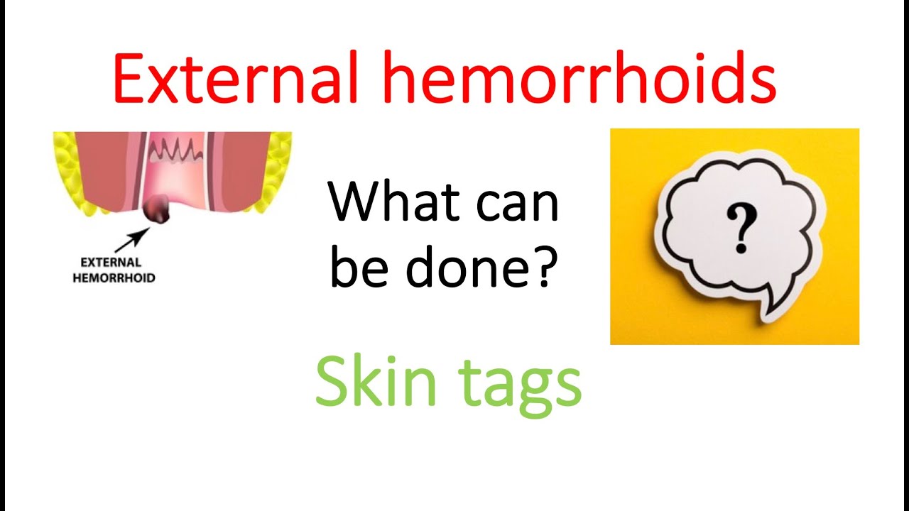 External Hemorrhoids And Skin Tags What Can Be Done Youtube