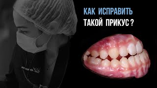 Что делать, когда нижняя челюсть выпирает вперед❓