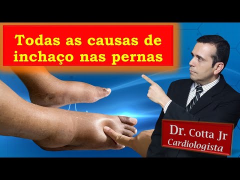 O que pode ser Inchaço nos Pés e nas Pernas? Vídeo definitivo sobre todas as causas e como resolver