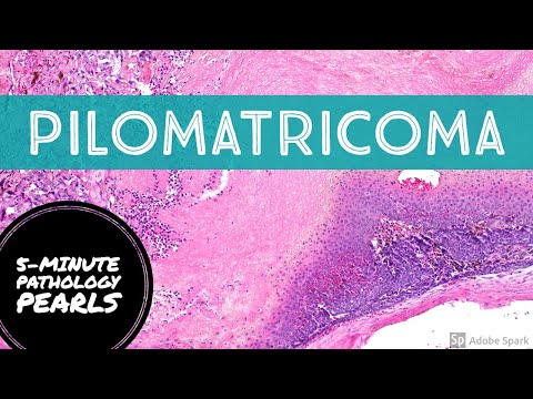 Pilomatricoma: 5-Minute Pathology Pearls