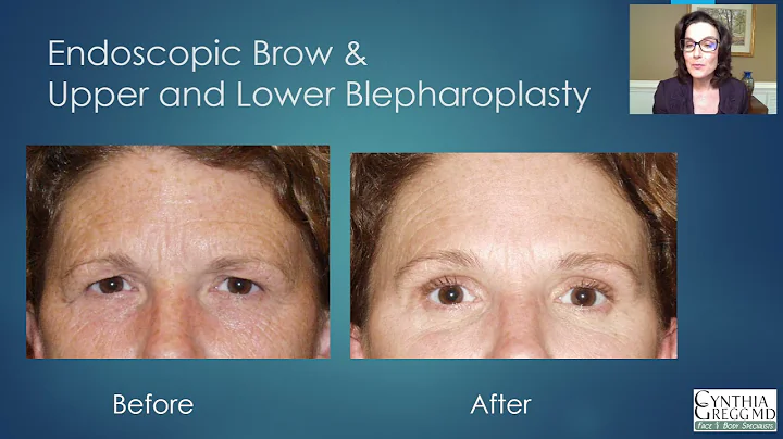 Which Eye Rejuvenation Procedure is Best for You?