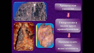 Патология - Лекция (стом. фак) - Болезни дыхательной и пищеварительной систем