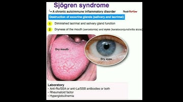 Sjogren syndrome #doctor #shortsfeed #short #shortsvideo
