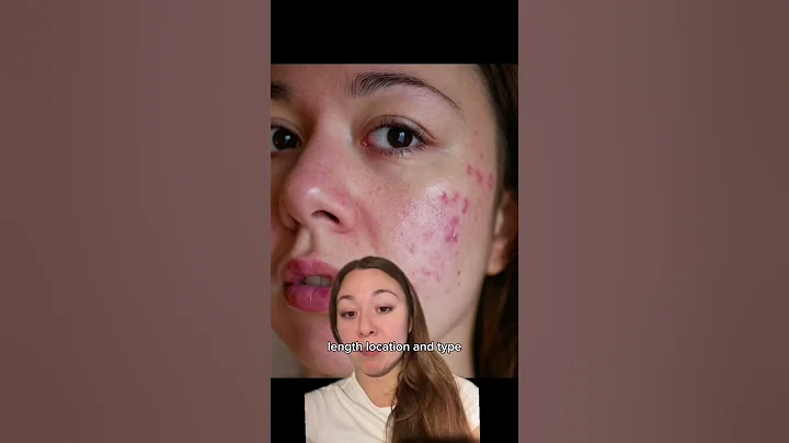 Suddenly breaking out? This is what you need to know about ”skin purging” VS acne! #acne